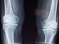 Osteoarthritis diagnosis no longer a letter of resignation