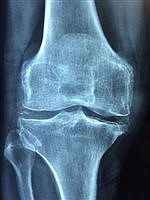 Breaking Point: Preventing osteoporosis