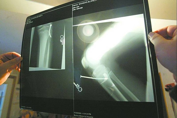 Dan Thrift/Nevada Appeal News Service An X-ray reveals the four-inch nail that went into Blake Shamas&#039; left knee during a sledding accident near his South Shore home. Injuries such as his are not unusual for this area this time of year.