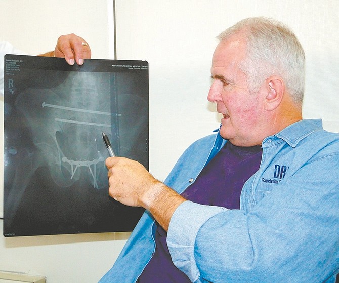Courtesy Dan Burns/Communications Director for GovGov. Jim GIbbons points to an X-ray that shows the 10-inch bolts that are holding his pelvis together. Gibbons broke his pelvis when he was thrown from a horse two weeks ago.