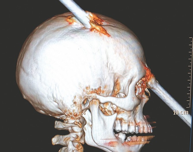 This tomography scan released Thursday, Aug. 16, 2012 by the Miguel Couto hospital, shows the skull of 24-year-old construction worker Eduardo Leite pierced by a metal bar in Rio de Janeiro, Brazil. Doctors say Leite survived after a 6-foot metal bar fell from above him and pierced his head. Luiz Essinger of Rio de Janeiro&#039;s Miguel Couto Hospital Friday told the Globo TV network that doctor&#039;s successfully withdrew the iron bar during a five-hour-long surgery. (AP Photo/Miguel Couto Hospital)