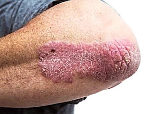 Psoriasis can strike most part of the body and affects more than 7 million people in the United States.