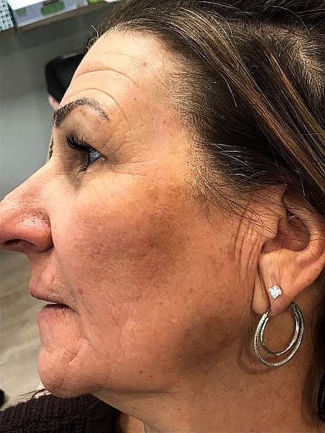 AFTER: Laura Rau of Gardnerville says she is overjoyed with her skin resurfacing results, which targeted dark sun spots, fine lines and texture over the course of three treatments.
